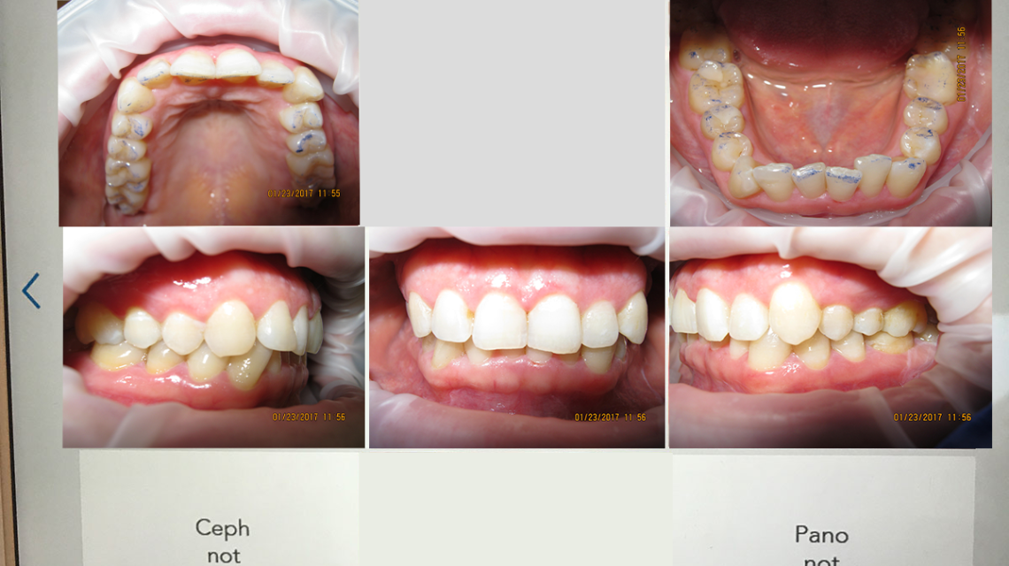 Patient Molly Papiin Teeth